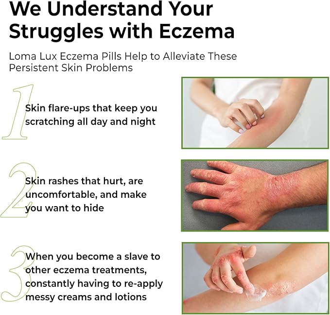 Loma Lux Eczema Pills – Natural Eczema Treatment Relief Remedy – Dermatologist Developed – 7 Minerals Clear & Prevent Severe Eczema Scaling, Rash, Anti Itch Skin Body Face for Adults, Kids, Toddlers