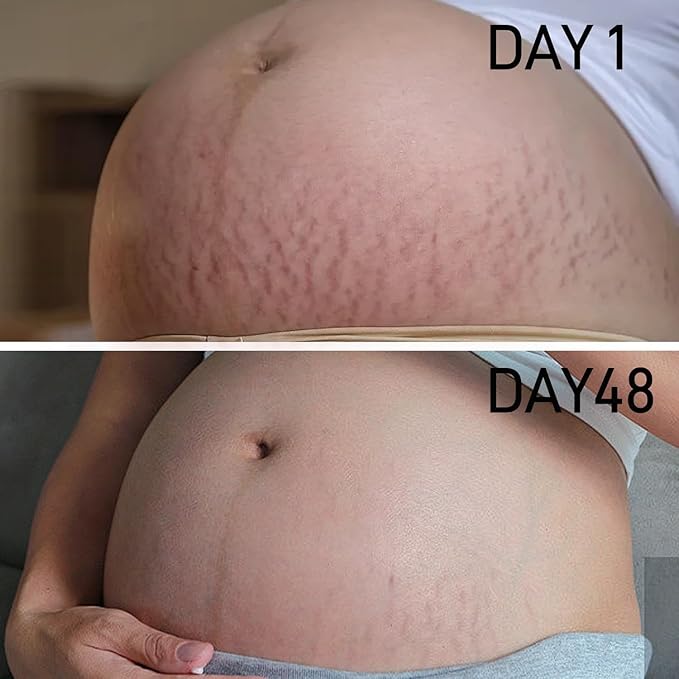 Stretch Mark Belly Butter-Packed with Vitamin E, Coconut Oil, and Sunflower Seed Oil to Protect, Soothe, and Rejuvenate Skin - Safe for Pregnancy and Nursing-Repair Stretch Marks and Scars.7.055oz