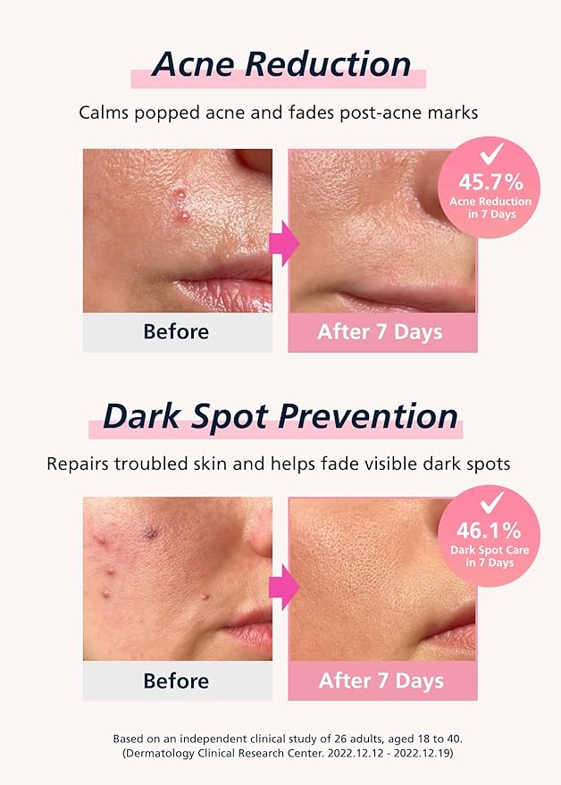 Easyderm Real Calming Patch Pimple Patches, Niacinamide, Hyaluronic Acid, EGF, K-Beauty Skincare | 6 Patches per Pack, 3 Packs (18 Total)