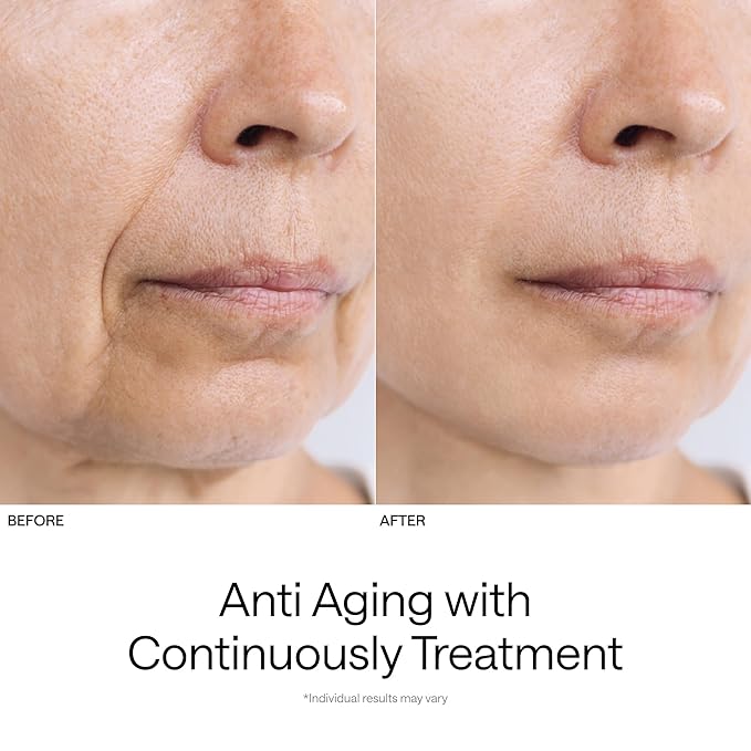 Ulike ReGlow Lite LED Mask With 3 Modes for Anti-Acne & Anti-Aging, Powerful LED Beads With Red, Blue and Mixed Light, 3D Facial Comfort Fit, Red Light Therapy Skin Care At Home