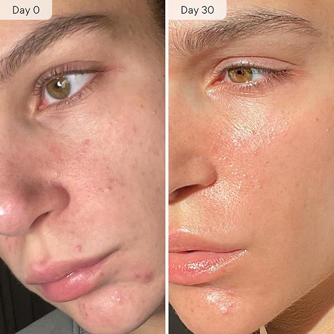 Qure Micro Infusion System for Face & Neck - Facial Moisturizing Essence, Hydrating Serum for All Skin Types, Refreshed Skin - 2-Month Supply