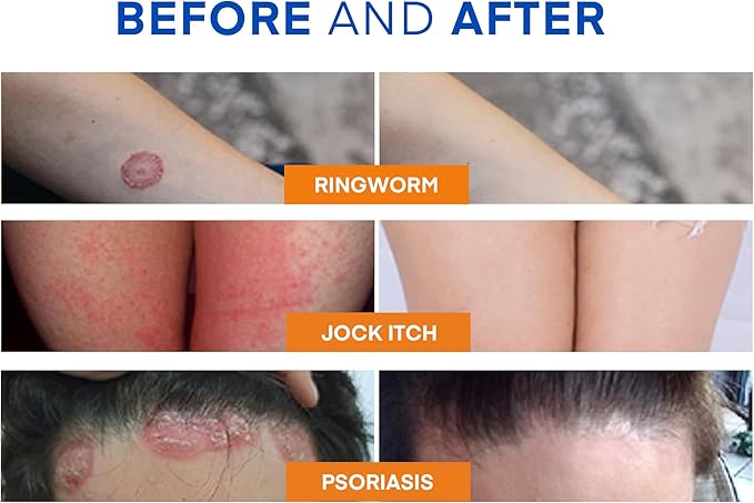Hermon Ringworm Treatment Anti-fungal Kit - RingWorm Treatment for Humans 3.52 oz cream 4 oz soap bar for Ringworm, Athlete's Foot, Jock Itch, Eczema, Tinea - for Adults and Kids