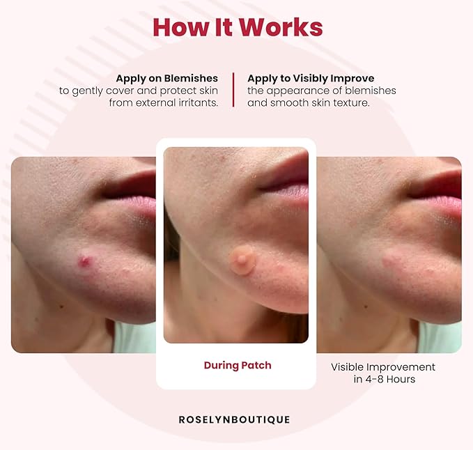 ROSELYNBOUTIQUE Pimple Patches for Face 300 Counts 4 Sizes Hydrocolloid Acne Patches with Tea Tree Oil,Zits Blemishes Pore Strips - Vegan Facial Skin Care Products Cruelty-Free