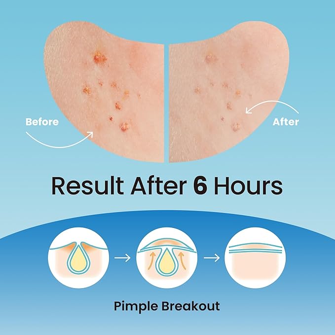 Ultra Invisible Salicylic Acid Acne Patches & Large Pimple Patches for Nose, Forehead, and Chin – Hydrocolloid, Zit, and Spot Treatment for Cystic Acne, Breakout Control, 148 Patches Bundle