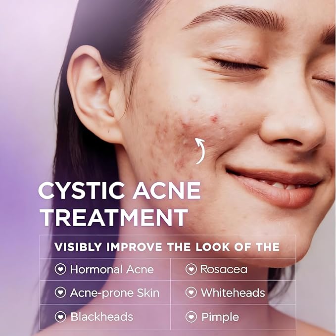 Cystic Acne Treatment for Face – Hormonal Acne Spot Treatment Pimple Cream with Azelaic Acid | Redness Reducing Acne Moisturizer for Rosacea & Sensitive, Acne-Prone Skin | Teens & Adults, 1.7 oz