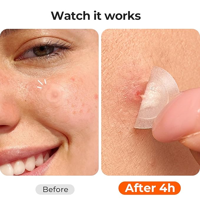 TKTK Pimple Patches for Face, 0.01cm Ultra-Thin Invisible Acne Patches, Hydrocolloid Patches for Breakouts, Absorbs Zits & Blemish, Suitable Under Makeup, 2 Sizes(10mm/12mm) 168 count