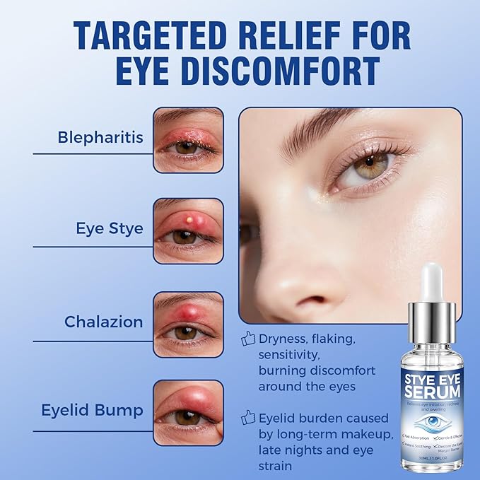 Stye Eye Treatment, Natural Relief Serum for Styes, Chalazions and Blepharitis, Blepharitis Treatment for Eyelids, Quickly Relieves Eyelid Irritation and Restores Healthier Skin, 30ML