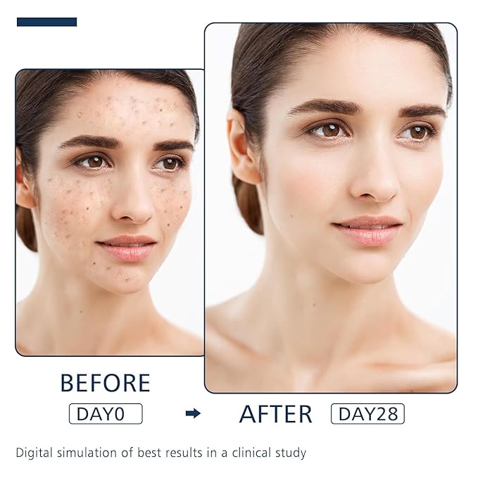 Dark Spot Remover for Face and Body - Dark Spot Advanced Corrector Serum for Melasma, Age Spots, Freckles & Sun Spots with 360° Roller for All Skin Types 0.67floz