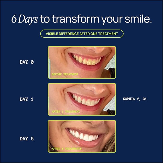 Laughland Sensitive Teeth Whitening Kit, Phone-Powered LED Mouthpiece & 3 Whitening Gel Syringes, Sodium Bicarbonate, Aloe Vera & Mint, Gentle Formula, at-Home Dental Care, 6+ Treatments