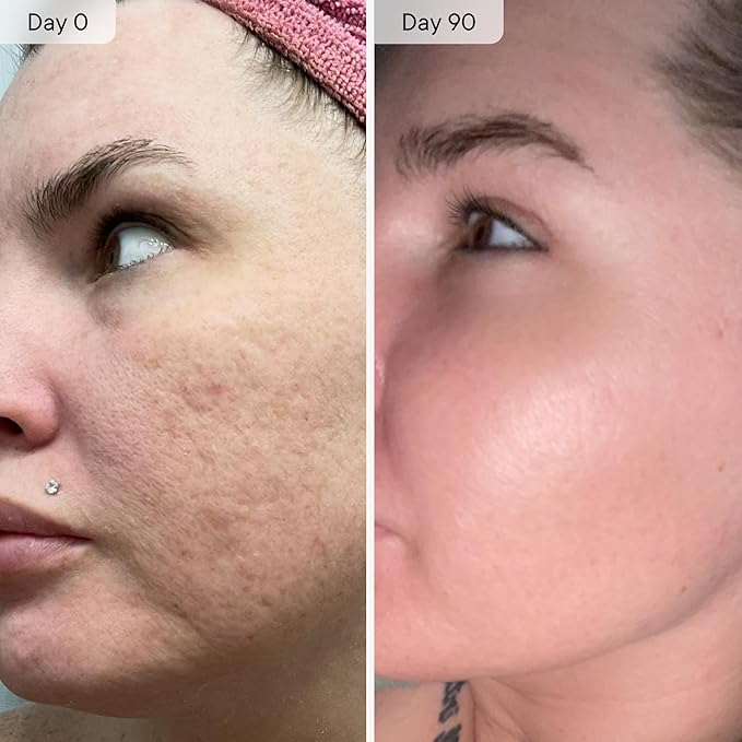 Qure Micro-Infusion System for Face - Clear Formula for All Skin Types, Easy 5min at-Home Skincare Facial Application - 2 Month Supply