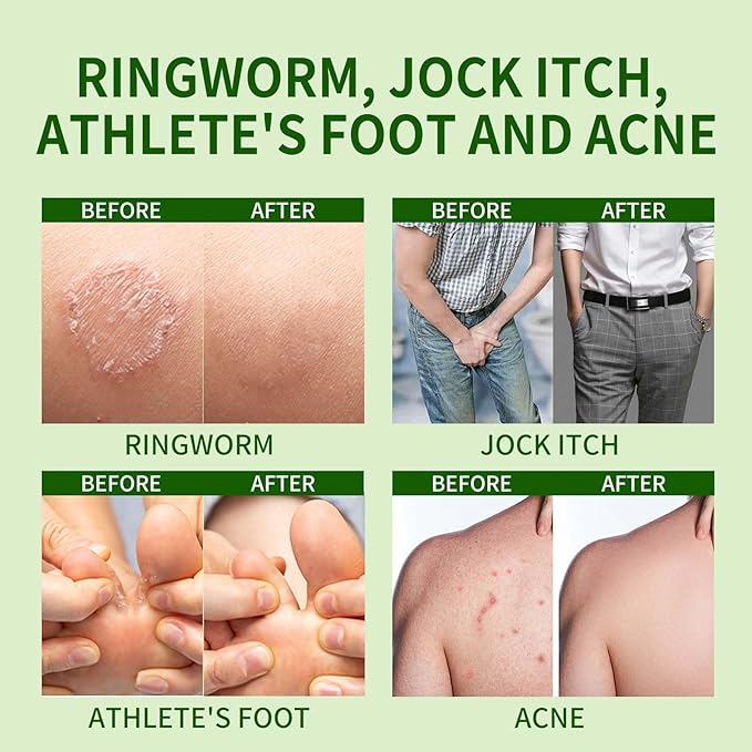 Tuymec Antifungal Bar Soap - Skin Fungus Treatment for Athlete’s Foot, Jock Itch & Ringworm - Medicated Anti Fungal Skin Soap with Clotrimazole 1% & Tea Tree Oil (2 Bars, 1 Case)