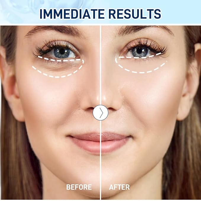 Under Eye Patches for Dark Circles, Eye Patches for Puffy Eyes and Dark Circles, Parches Para Ojeras - Skin Care Deep Hydrating & Firming Eye Treatment