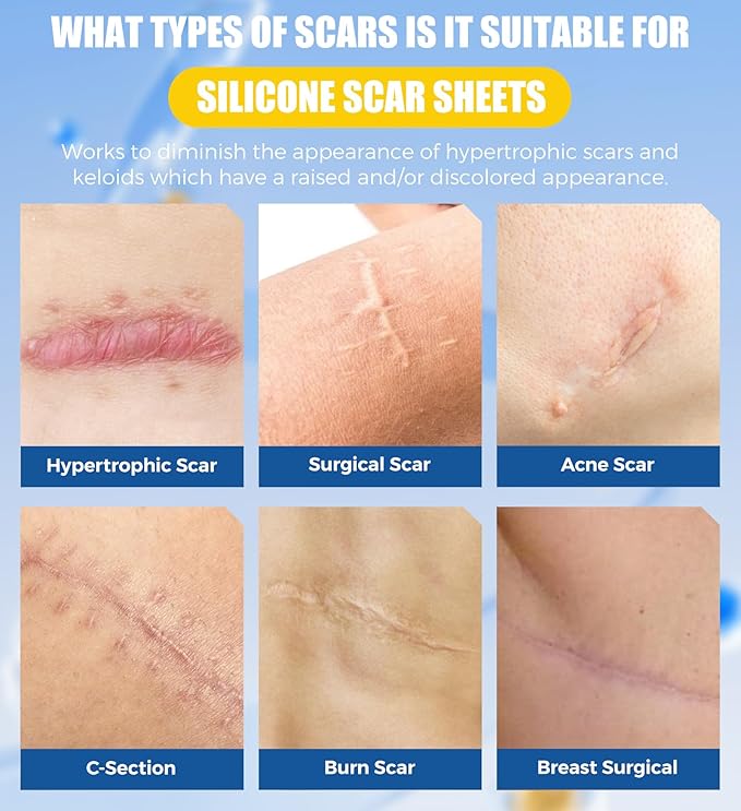 Medical Grade Silicone Scar Sheets & Tape - 1.6”x60" Roll, Ultra Soft, Hypoallergenic Rolls for Surgical, C-Section, Tummy Tuck, Keloid Scars, Stretch Marks & Burn Scar Removal