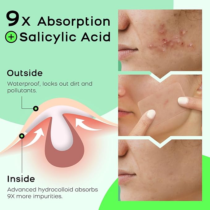 XL Hydrocolloid Acne Patches - Extra Large Pimple Patches for Cystic Acne on Face & Body | Nose, Chin, Back & Bacne Treatment | Vegan & Cruelty-Free (10 Count)