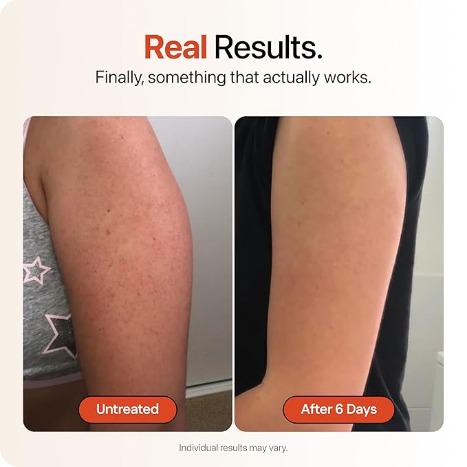 STRAWBERRY® Resurfacing Cream for Keratosis Pilaris - KP Bump Eraser Skin - Exfoliating Lotion with Glycolic, Lactic & Salicylic Acid - Remover for Rough & Bumpy Skin 8 oz (2 pack)