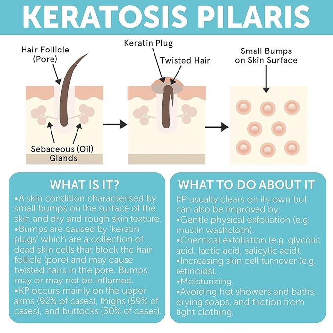 KP Bump Eraser Body Scrub | Keratosis Pilaris Treatment | Bump Eraser Body Scrub | Exfoliating Body Scrun | Ingrown Hair Treatment | Clears Strawberry Legs | Soothes Redness, Dryness & Flaky Skin