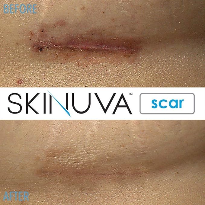 Skinuva® Next Generation Scar Cream - Advanced Scar Cream Formulated with Growth Factors (1 oz)