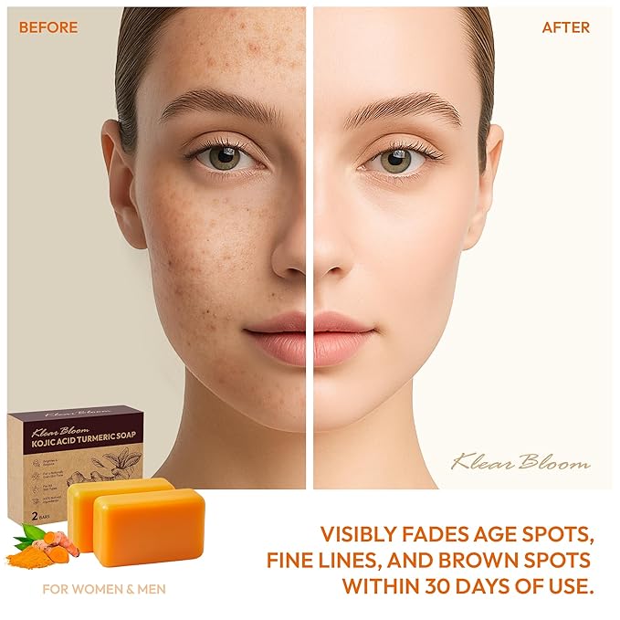 Kojic Acid Soap, Turmeric Soap Bar for Dark Spots Brightening & Moisturizing with Collagen, Vitamin E, Retinol, Hyaluronic Acid, Shea Butter, Paraben & Sulfate-Free 105g x 2 Bars