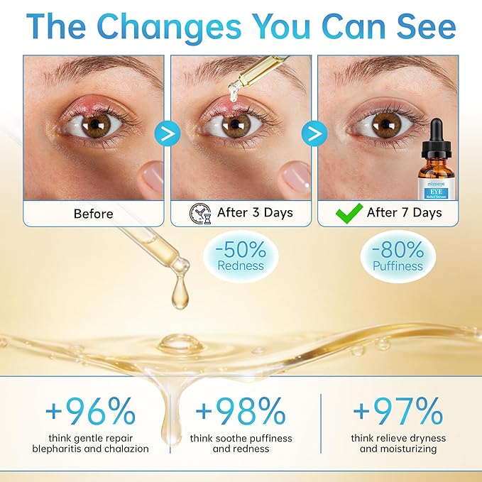 Eye Serum For Chalazion & Blepharitis, 2 PCS Chalazion Remover For Eyelid, Eyelid Serum With Avocado Oil, Sea Buckthorn Oil & Caffeine, Relieve Puffiness and Eye Fatigue