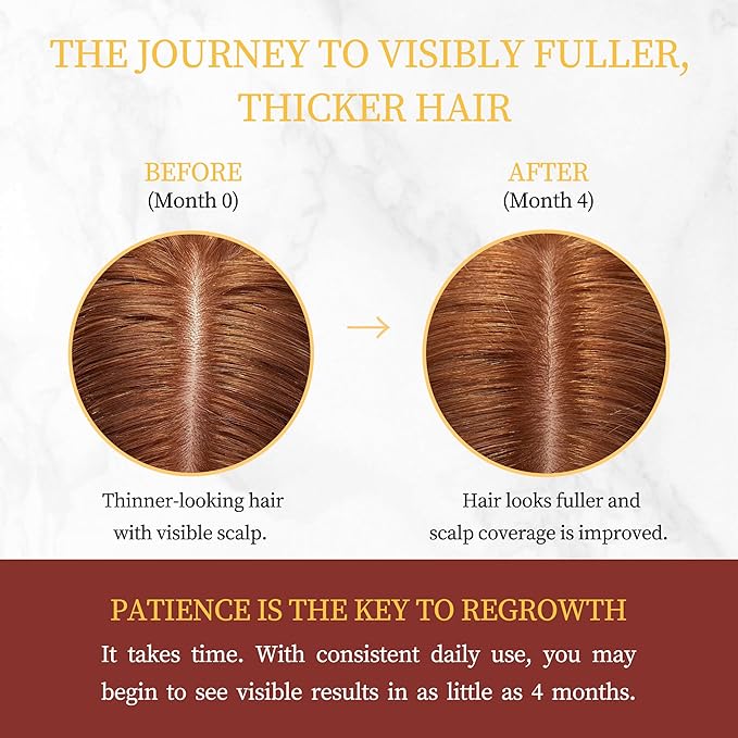 Minoxidil for Women Hair Growth with Biotin, Extra Strength Topical Minoxidil Serum Solution with Rosemary for Hair Regrowth Treatments, Non-Greasy, Helps Prevent Hair Thinning & Hair Loss