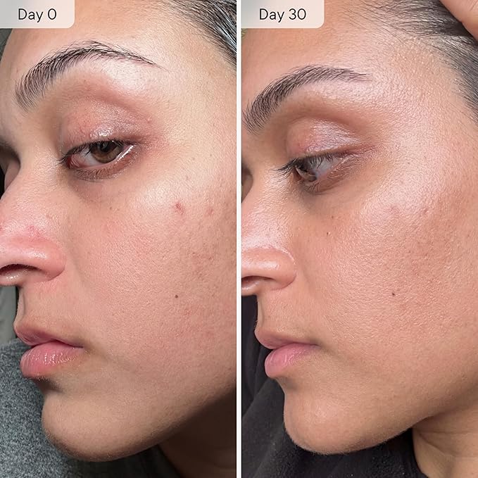 Qure Micro-Infusion System for Face - Clear Formula for All Skin Types, Easy 5min at-Home Skincare Facial Application - 2 Month Supply