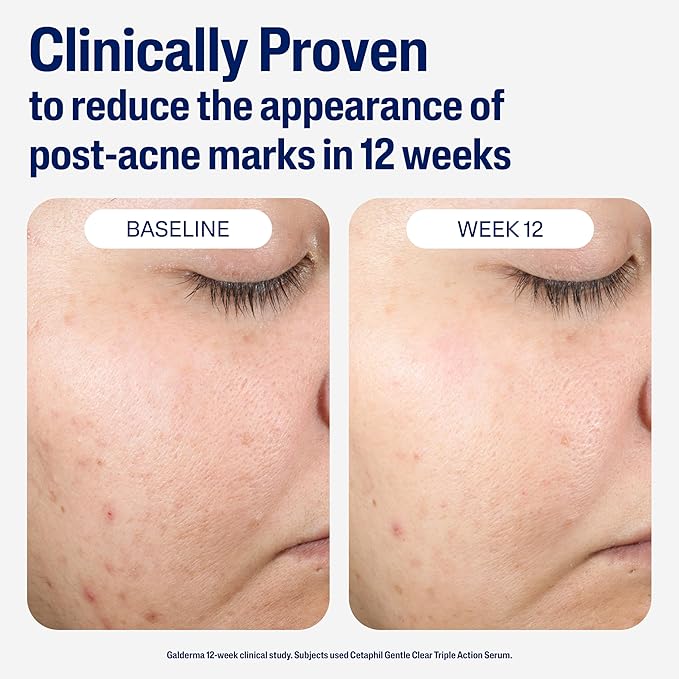 CETAPHIL Gentle Clear Repairing Post-Acne Serum, Retinol Alternative, Oil Free Serum for Sensitive Skin, 1 Fl Oz, Bakuchiol, Improves Skin Tone & Post-acne Marks, Dermatologist Recommended Brand