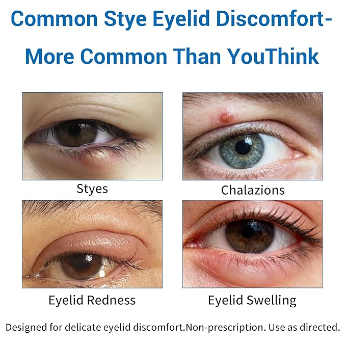 Stye Eye Treatment Product, Relief for Styes, Chalazions, Blepharitis, Dry Eyes, Irritation and Swelling; Clear Eyes Redness Relief, Eye Stye Treatment, Soothing Eyelid Comfort, 30ml 1 Fl Oz