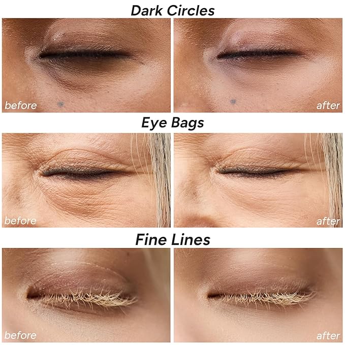 Under Eye Patches for Dark Circles, Fine Lines, Puffy Eyes and Under Eye Bags Restoring Gel With Caffeine & Hyaluronic Acid 360° Coverage Hydrating Eyes Masks 5 pairs