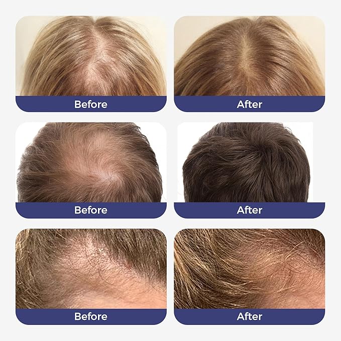 Hair Growth Serum Roll On,3% Rosemary, 6% Batana oil,3% Redensyl & 2% Anagain| No-Rinse, Fast-Absorbing | For Thinning Hair & All Hair Men & Women (2 Pcs)