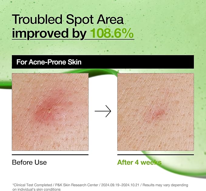 Anua Azelaic Acid Redness Care Duo, Azelaic Acid 3 CICA Skin Clarifying Toner & Azelaic Acid 10 Hyaluron Redness Soothing Serum, Blemish & Redness Care Routine for Sensitive Skin, Korean Skincare