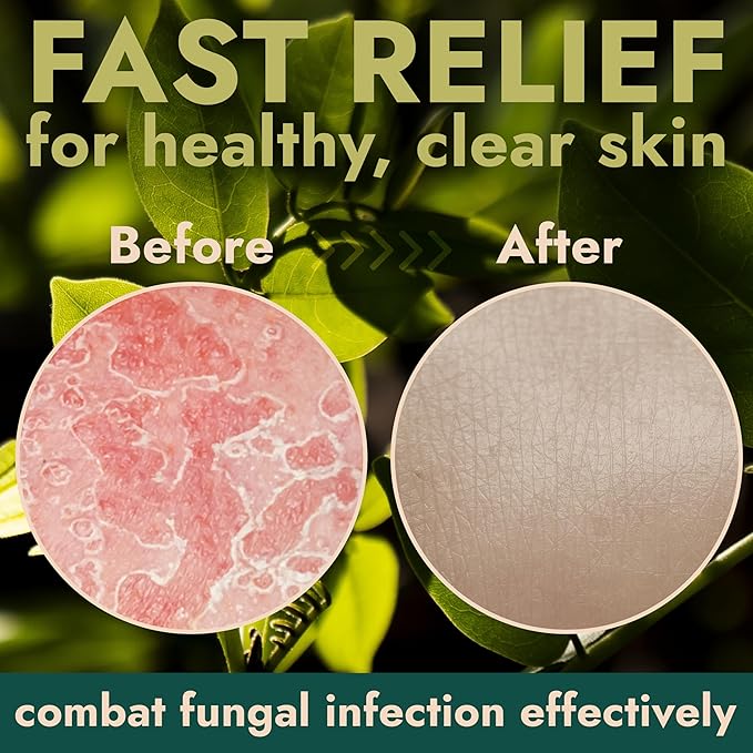 Antifungal Soap Pack of 2 | Medicated Jock Itch Treatment, Fights Ringworm & Athlete's Foot | Antibacterial Soap Includes Scrubber for Deeper Cleansing & Exfoliation | Tea Tree Oil 1% Tolnaftate