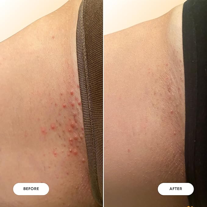 Bushbalm Ingrown Hair Oil - Helps Reduce, Repair Skin from Ingrown Hairs, Razor Bumps & Underarm Bumps - Soothe Skin from Post Shave Itchiness 30 ml - Vanilla Tangerine Oil - Formerly Sweet Escape