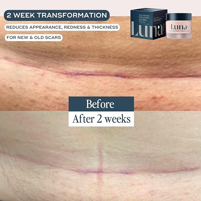 Luna Daily Stretch Mark & Scar Treatment Gel | Daily Repair Moisturizer for Body, Acne & Post-Surgery Scars | With Arnica & Hydrating Actives | Supports Skin Healing, Smoothness & Recovery, 50ml