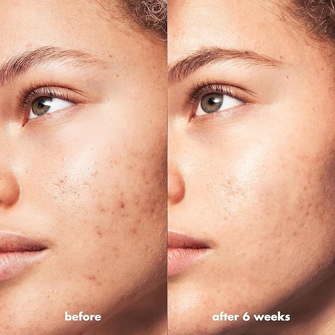 e.l.f. SKIN Blemish Breakthrough Clarifying Cleanser, Gel Cleanser For Removing Makeup, Controlling Oil & Clarifying Pores, 1% Salicylic Acid