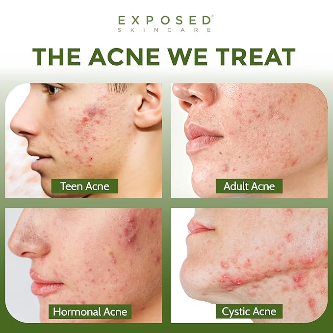 Exposed Skin Care, Acne Treatment Serum with 3.5% Benzoyl Peroxide – Lightweight Acne Spot Treatment – Quickly Clear Teen, Adult, Hormonal and Cystic Acne – Natural, Non-toxic and Cruelty Free