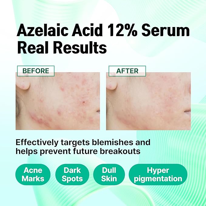 Azelaic Topical Acid 12% Serum for Face – Dark Spot Remover with Tranexamic Acid, Salicylic Acid, Niacinamide & Centella Asiatica – Acne, Hyperpigmentation & Rosacea Treatment 1 Oz Korean Skincare