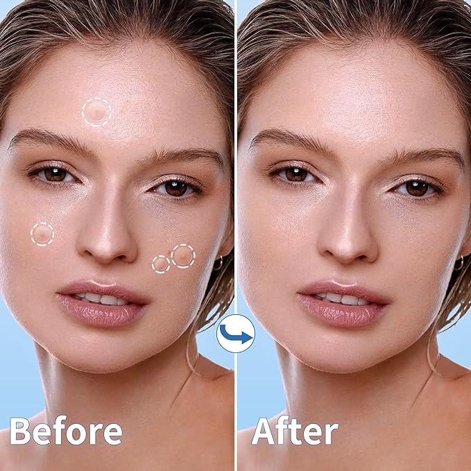 Pimple Patches for Face - 4 Size 700 Counts Acne Patches, Hydrocolloid Patches for Covering Zits and Blemishes, Spot Stickers with Salicylic Acid, Tea Tree Oil & Calendula Oil