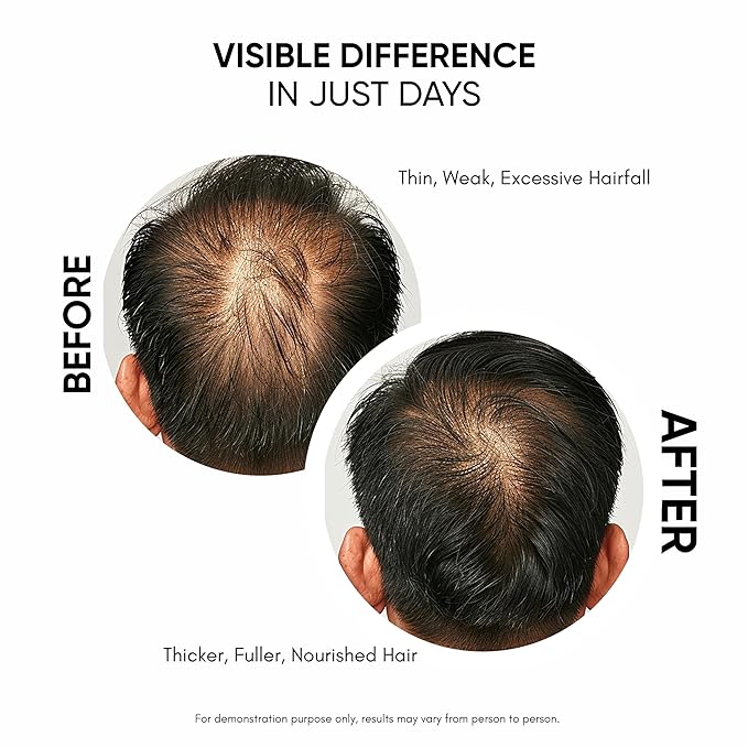 Hair Growth Serum For Promoting Hair Growth & Controlling Hair Fall With 3% Redensyl, 5% Capixyl, 4% Anagain, 3% Procapil & Rosemary & Biotin, For Both Men & Women, 50 ml (Pack of 1) White