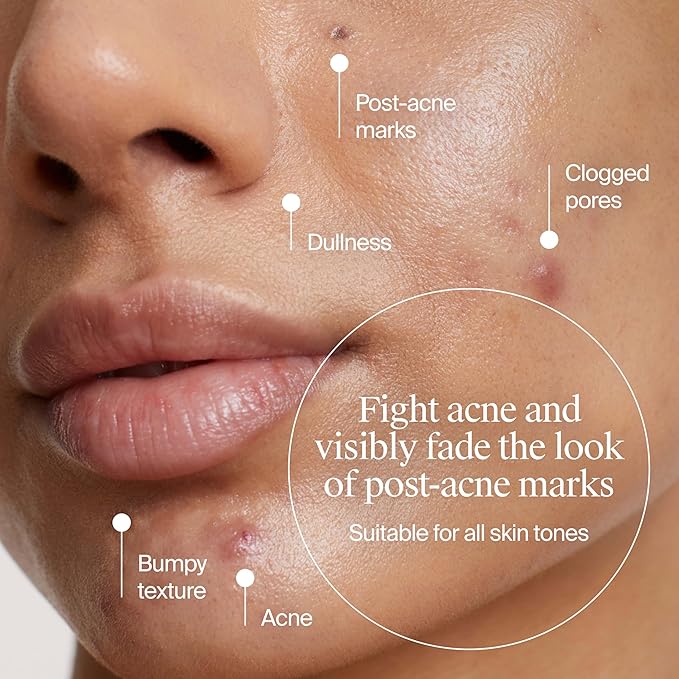 Neutrogena Evenly Clear Acne Exfoliant with Salicylic Acid & Mandelic Acid, Multi-Acid Exfoliating Treatment Serum Visibly Fade the look of Post-Acne Marks for A Smooth, Even Skin Tone, 1 fl. oz