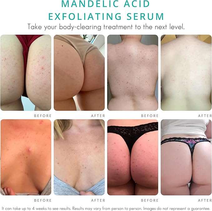 Almond Clear Level 2 Serum | Mandelic Acid Body Serum for Acne, Folliculitis, Aging Skin, Ingrown Hairs, Dark Spots on Face, Chest, Butt, Back, Thighs, Arms | 4 oz