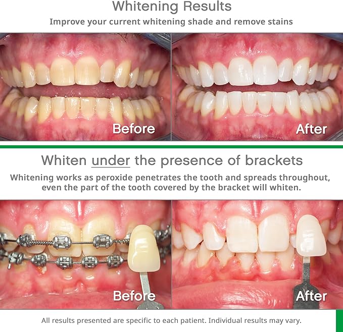 Opalescence Go 10% Whitening Bundle - (10 Treatments) Hydrogen Peroxide 10% Prefilled Whitening Trays and Whitening Toothpaste - Made by Ultradent Products. Teeth Whitening Kit -Mint- 5194-5166
