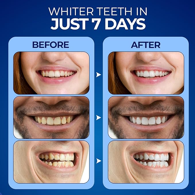 Euphauria Sensitive Teeth Whitening Kit with LED Light At Home, 12% Hydrogen Peroxide Teeth Whitening Gel Pen (Pack of 3), Enamel Safe, Rechargeable Wireless Red & Blue UV Whitening Spectrum with Case