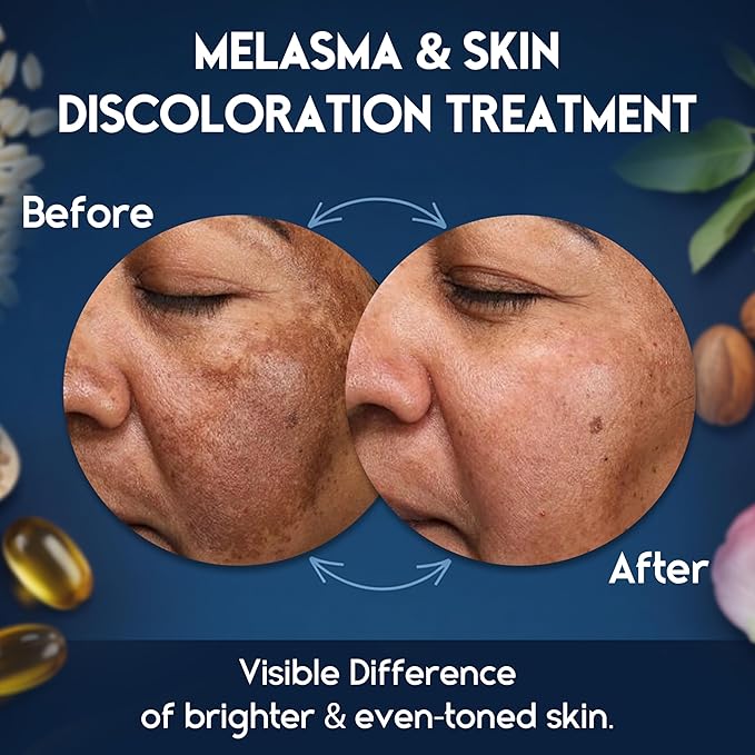 Meladerm Treatment for Face