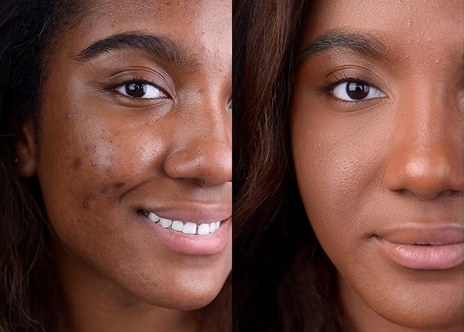 The Good Mineral Loves-You-Back 3in1 Mineral Powder Foundation (CARAMEL 4) | Designed for Acne-Prone, Sensitive Skin | Hyperpigmentation | Covers Dark Circles | 3IN1 - Concealer, Foundation + Powder