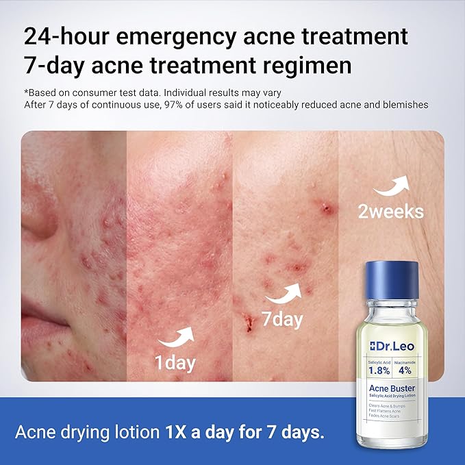 Dr.Leo 1.8% Salicylic Acid Spot Serum, Acne Treatment for Acne-Prone Sensitive Skin | Niacinamide, Fast Pimple Relief, Fades Acne Marks, Overnight & Period Breakouts, 0.34 fl oz (20 ml)