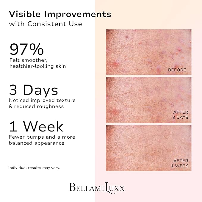 BellamiLuxx Butt Acne Treatment Set: Acne Soap Bar + Butt Treatment Lotion for Breakouts on Buttocks, Thighs, Back, Chest & Ingrown-Prone & Folliculitis-Prone Skin – Helps Reduce Body Breakouts