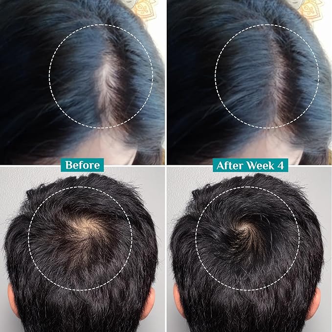 Pilgrim Advanced Hair Growth Serum with Redensyl 3%, Anagain 4% & Baicapil | Hair Fall Control & Regrowth | Korean Black Rice | For Men & Women, 3.38 Fl Oz (100ml)