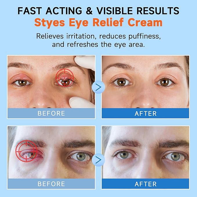 BECHOICEN Stye Eye Relief Gel with Tea Tree Oil,Calendula & Vitamin E–Gentle Soothing Serum for Styes,Chalazion & Blepharitis,Soothing Eyelid & Under Eye Care for Redness,Irritation & Puffiness,1.4oz