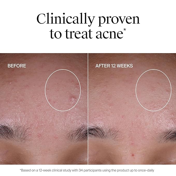 Neutrogena Evenly Clear Acne Exfoliant with Salicylic Acid & Mandelic Acid, Multi-Acid Exfoliating Treatment Serum Visibly Fade the look of Post-Acne Marks for A Smooth, Even Skin Tone, 1 fl. oz