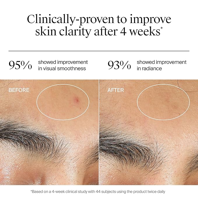 Neutrogena Evenly Clear Acne Gel Moisturizer with Salicylic Acid & N-Acetyl Glucosamine, Lightweight Non-Greasy Face Moisturizer Helps Treat Breakouts & Visibly Fade the look of Post-Acne, 1.7 fl. oz